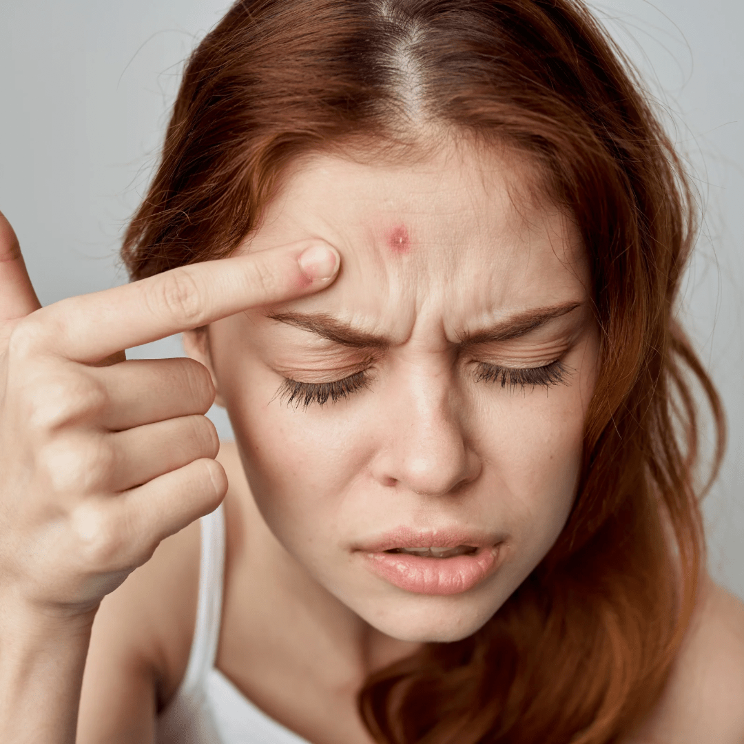Unreine Haut? Salicylsäure als natürliche Lösung! - Doriana Cosmetics GmbH
