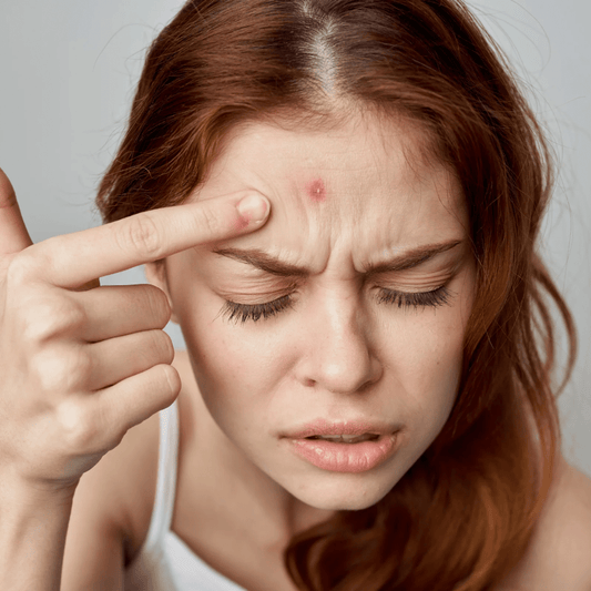 Unreine Haut? Salicylsäure als natürliche Lösung! - Doriana Cosmetics GmbH