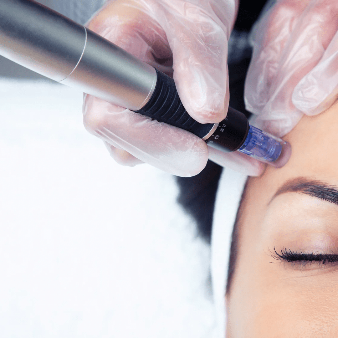 MICRONEEDLING - Gesichtsbehandlungen - (POS) - Doriana Cosmetics GmbH